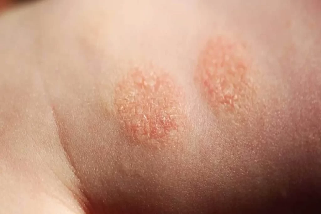 Close-up de dois círculos de pele avermelhada, seca e áspera com descamação e pequenas bolhas, tipicamente associados a um surto de dermatite atópica (eczema).