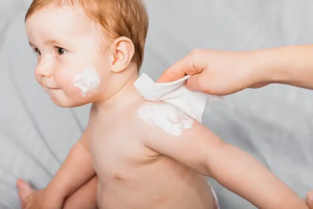 Mãe aplicando creme no ombro de um bebê com manchas de roséola no rosto e no corpo, enquanto ele está sentado em uma superfície macia.