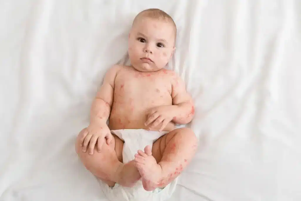 Bebê deitado em superfície branca com erupção cutânea avermelhada no corpo e rosto, indicando possível roseola.