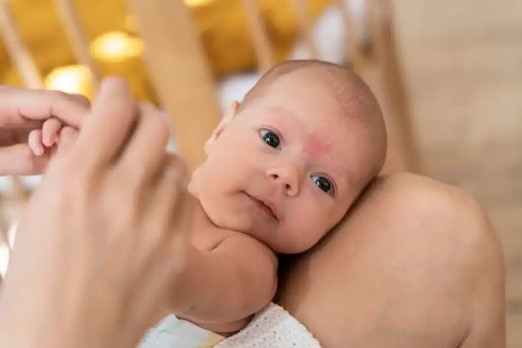 Bebê deitado no colo de um adulto, com expressão serena, e com marcas de roséola visíveis na testa.