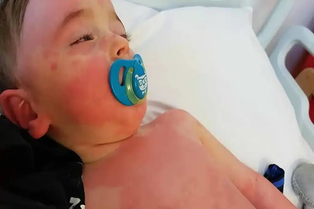 Uma criança pequena, deitada, com manchas vermelhas na pele do rosto, pescoço e tronco, segurando uma chupeta. A imagem ilustra o sintoma de erupção cutânea da Doença de Kawasaki.