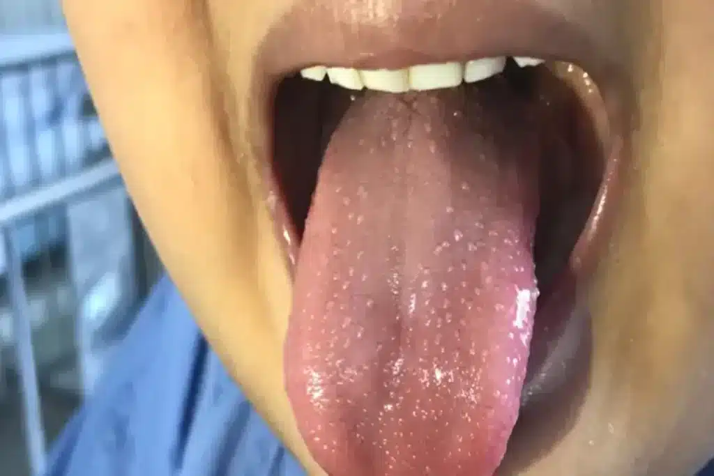 Close-up da boca de uma pessoa, mostrando a língua inchada com pequenas protuberâncias, um sintoma conhecido como "língua em framboesa", característico da Doença de Kawasaki.