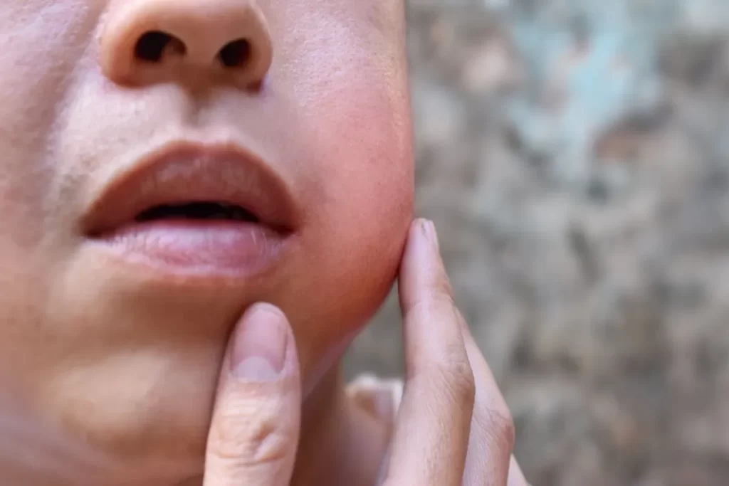 Close-up do rosto de um adulto, mostrando o inchaço e vermelhidão na região do ângulo da mandíbula e bochecha (onde fica a glândula parótida). Um dedo está tocando suavemente a área inchada, indicando dor ou desconforto. Esta é uma representação visual clássica do sintoma de caxumba (parotidite infecciosa).
