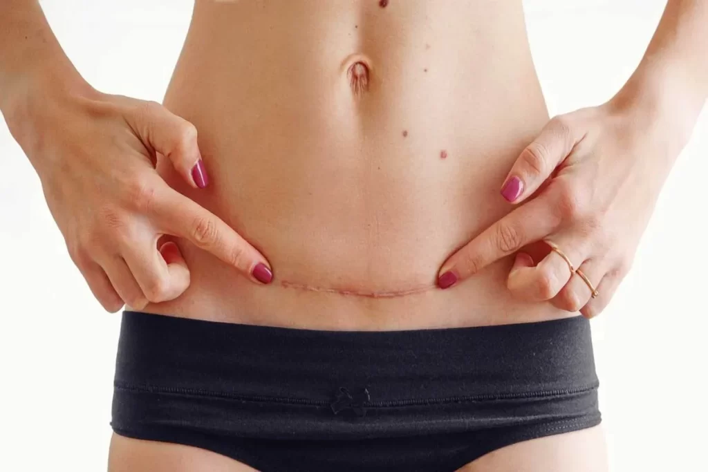Close-up do abdômen de uma mulher que aponta com os dedos indicadores para sua cicatriz de cesariana horizontal, localizada logo acima da calcinha preta.