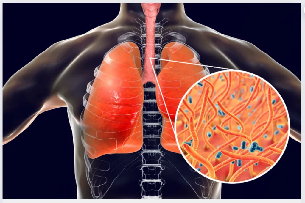 Ilustração médica 3D do sistema respiratório humano, mostrando o tronco, a traqueia e os dois pulmões em cor laranja-avermelhada. Um círculo de zoom no pulmão direito exibe a ampliação de microrganismos filamentosos (laranja) e bacilares (azuis), representando as bactérias Bordetella pertussis, que causam a doença respiratória contagiosa conhecida como coqueluche.
