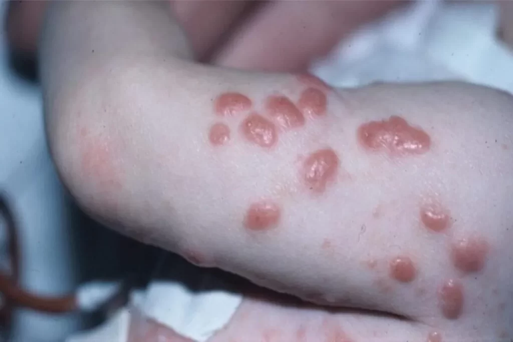 Lesões de escabiose na pele, com erupções avermelhadas e coceira intensa causadas pelo ácaro Sarcoptes scabiei.