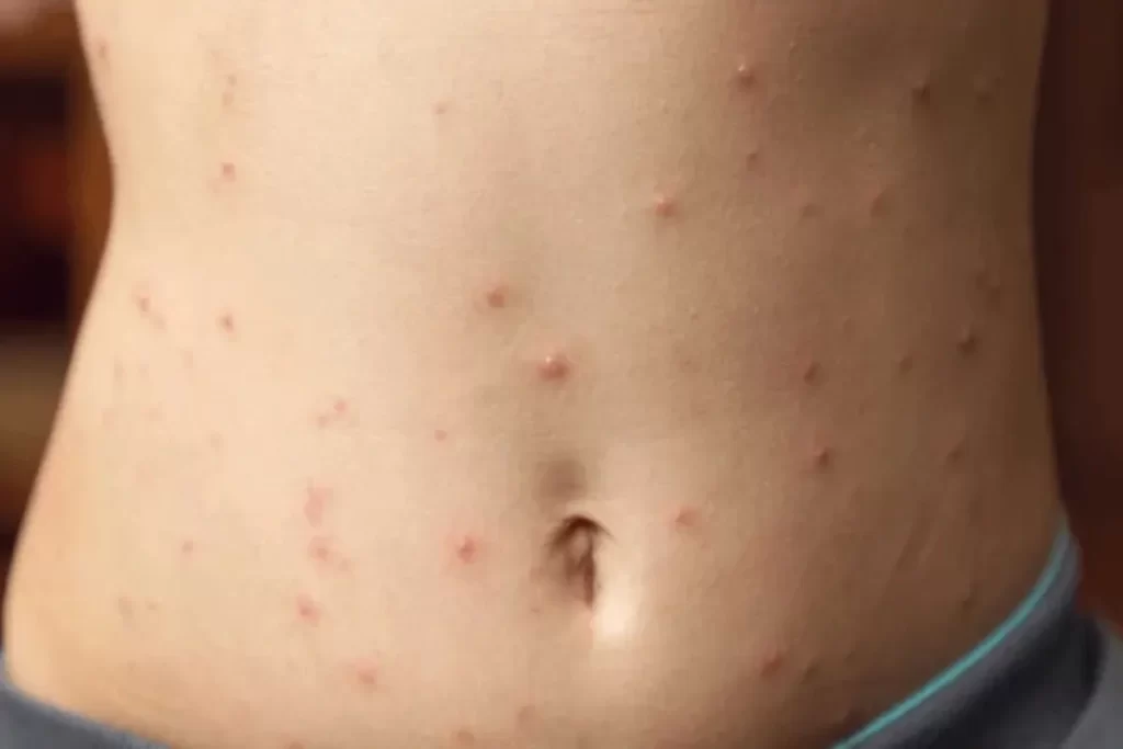 Escabiose: sintomas, diagnóstico e tratamento da sarna humana