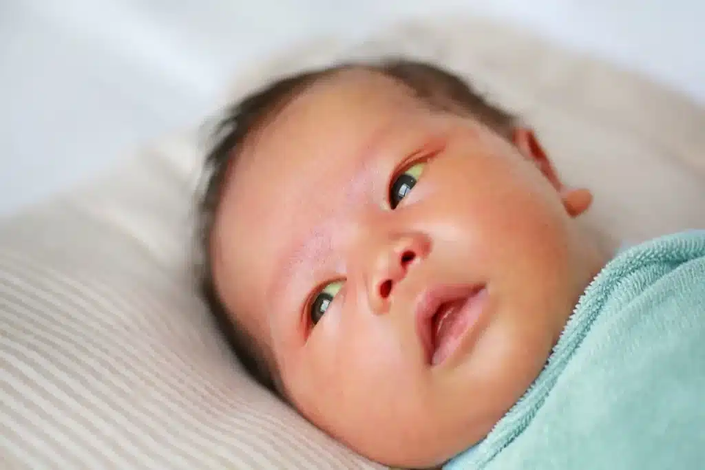 Bebê recém-nascido com pele e olhos amarelados devido à icterícia neonatal