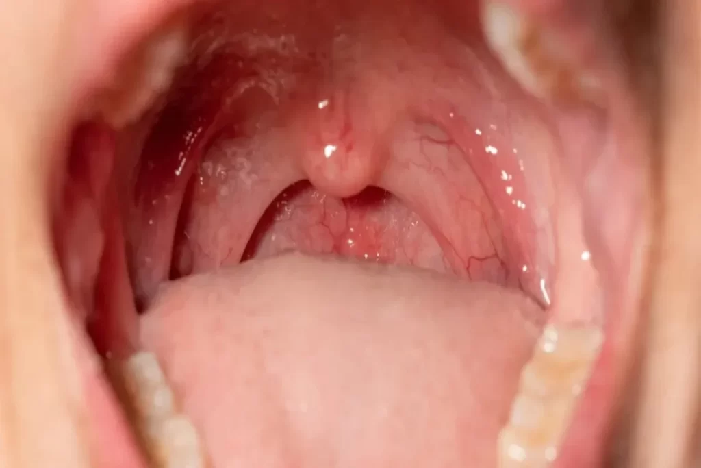 Imagem em close-up de uma garganta humana aberta, mostrando a faringe inflamada com vermelhidão e inchaço nas amígdalas (tonsilas palatinas) e na úvula. As paredes da faringe aparecem avermelhadas e com veias visíveis, indicando uma condição como faringite ou amigdalite.