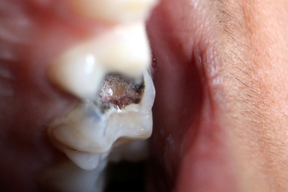 Close-up de dente de criança com cavidade causada por cárie dentária