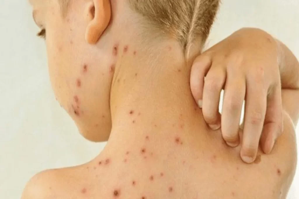 Criança coçando as costas devido à coceira intensa causada pela catapora.