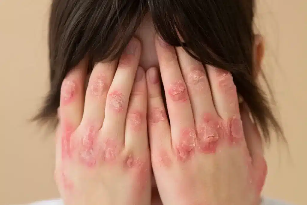 Dorso das mãos de pessoa com placas vermelhas, descamativas e áreas de vermelhidão intensa