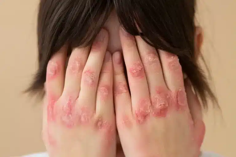 Dorso das mãos de pessoa com placas vermelhas, descamativas e áreas de vermelhidão intensa