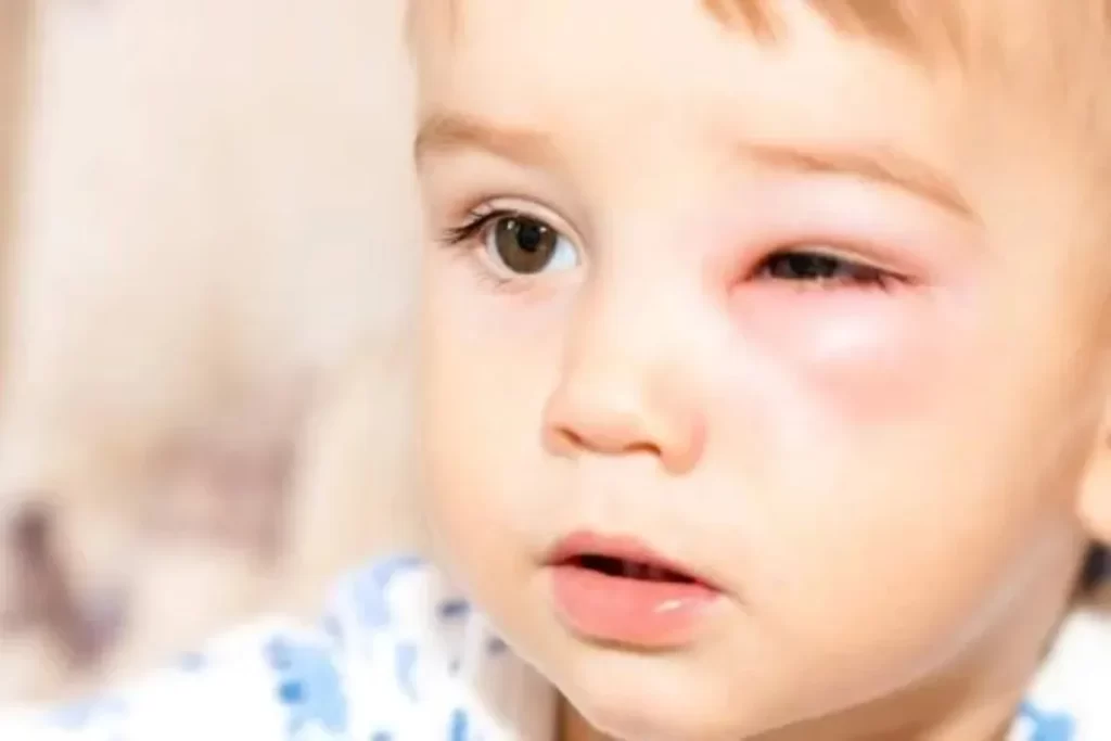 Conjuntivite em Crianças: Sinais, Sintomas e Cuidados Essenciais