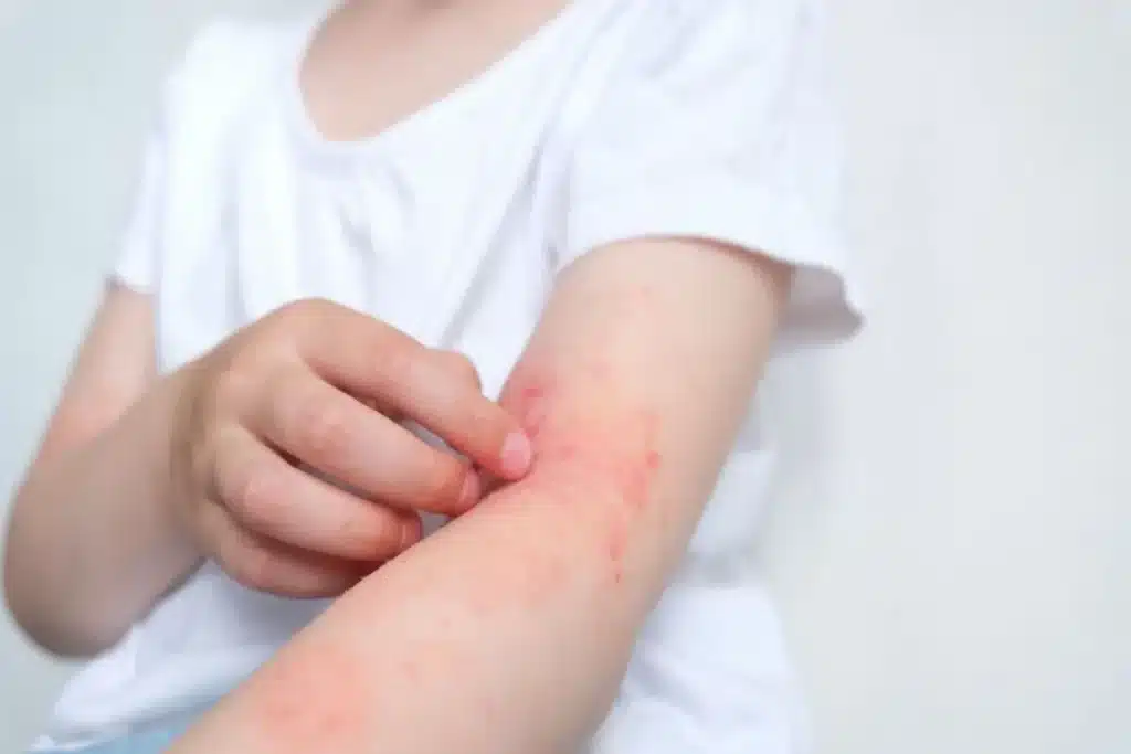 Criança coçando o braço com erupções cutâneas avermelhadas e irritadas, típicas de impetigo.