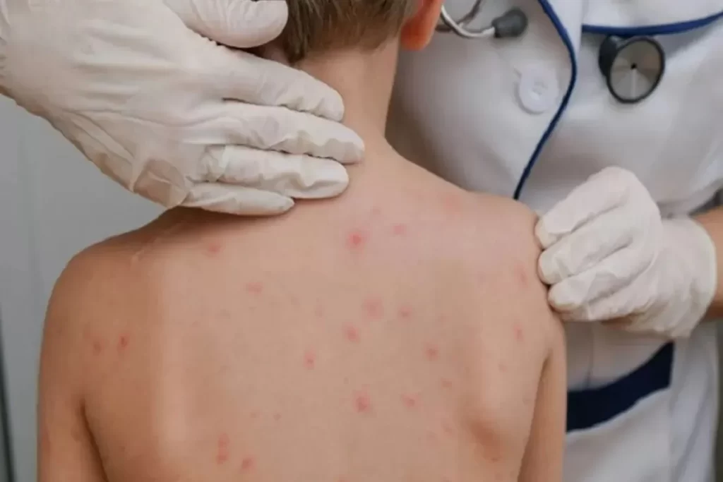 Escabiose em crianças: sintomas, diagnóstico e tratamento da sarna humana