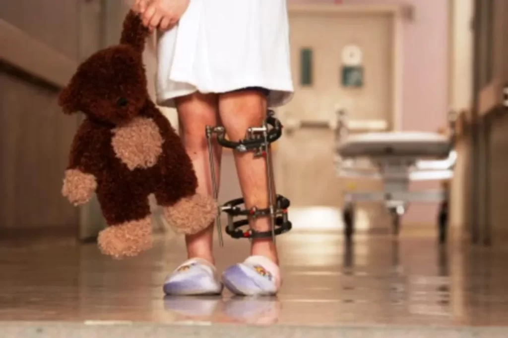 Um close-up de uma criança em um corredor de hospital. A criança, vestida com uma camisola branca, segura um urso de pelúcia marrom. Suas pernas estão com um aparelho ortopédico externo (fixador), que é uma sequela comum da poliomielite. A foto foca nas pernas e nos sapatos de hospital, simbolizando a importância da vacinação e os desafios da doença.