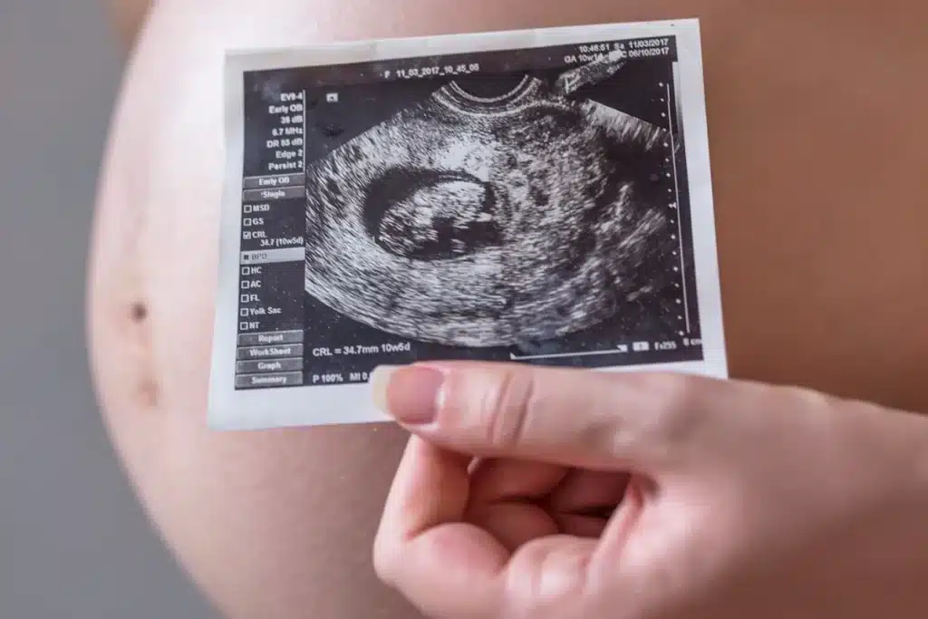 Mão segurando imagem de ultrassom sobre a barriga de uma mulher grávida, mostrando o embrião em fase inicial de desenvolvimento.